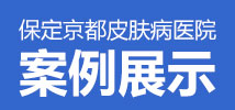 保定京都皮肤病医院白癜风专科医院